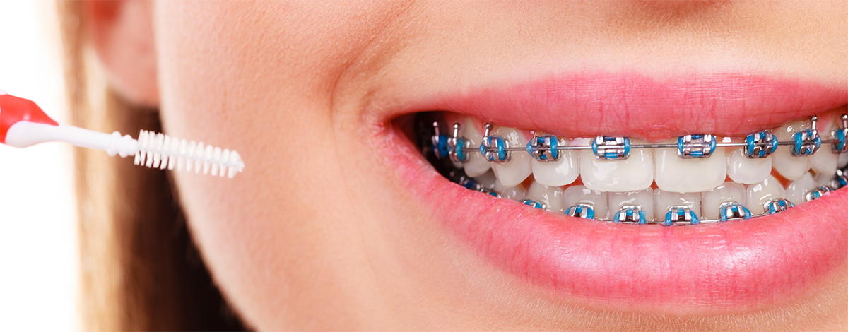 Ortodonti Hastaları Fırçalama Sıklığı