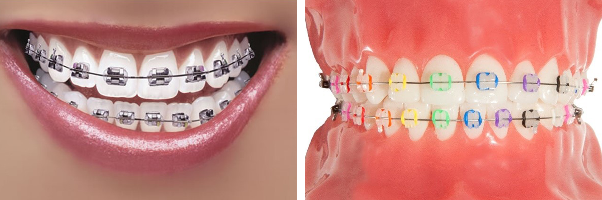 Sabit Ortodontik Aygıtlar