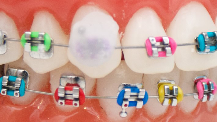 Sabit Ortodontik Tedavide Yaşanabilecek Sıkıntılar