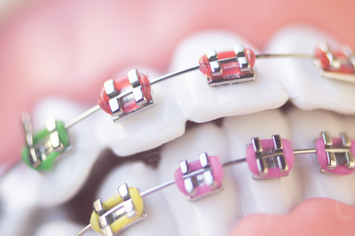 Ortodonti Tedavisinde Merak Edilenler