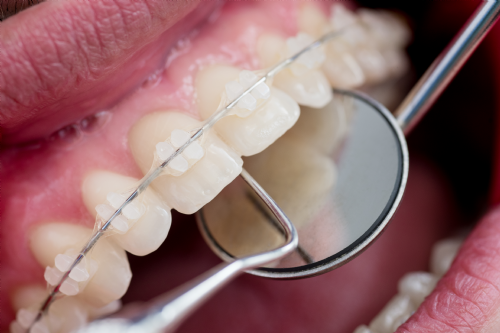 Ortodontik Problemler Tedavi Edilmezse Ne Olur?