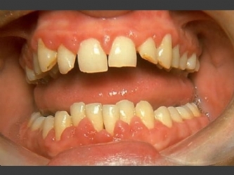 Ortodontik Problemler